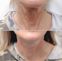 35-44 year old woman treated with Thread Lift