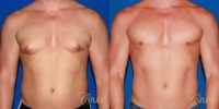 41 year old body builder treated with male breast reduction