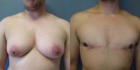 25-34 year old man treated with FTM Chest Masculinization Surgery