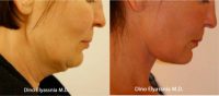 45-54 year old woman treated with Face Lift and Neck Lift