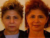 55-64 year old woman treated with face lift