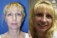 Facelift - Before and After