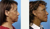 Dr. Frank L. Stile, MD, Las Vegas Plastic Surgeon - 37 Year Old Woman Treated With Facelift