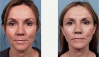 Dr. Frank L. Stile, MD, Las Vegas Plastic Surgeon - 39 Year Old Woman Treated With Facelift