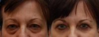Woman interested in improvement of her tired appearance.  (Eyelid Lift)