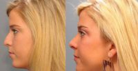 Woman 17 years old or younger treated with Rhinoplasty