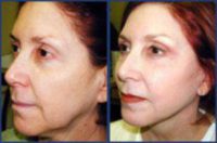 Awake facelift for jowls and facial aging