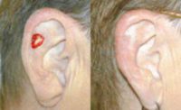 Skin cancer reconstruction on ear