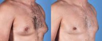 35-44 year old man treated with Male Breast Reduction
