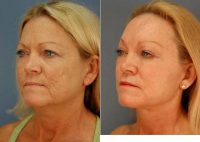 Dr. James B. Lowe III, MD, Oklahoma City Plastic Surgeon - 74 Year Old Woman Treated With Facelift