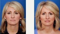 Dr. James M. Ridgway, MD, FACS, Bellevue Facial Plastic Surgeon - 37 Year Old Woman Treated With Facelift