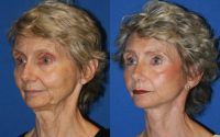 Facelift with Fat Grafting (Transfer)