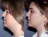 Neck liposuction in 38 year old woman