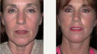 Dr. Jeff Angobaldo, MD, Dallas Plastic Surgeon - 64 Year Old Woman Treated With Facelift
