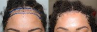 35-44 year old woman treated with Forehead Reduction
