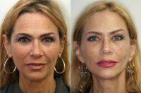 55-64 year old woman treated with Facelift, Necklift, and Endoscopic Forehead Lift