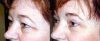 browlift and upper eyelid surgery