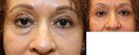55-64 year old woman treated with Eyelid Surgery