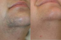 Laser Hair Removal Before and After Photos