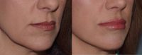 45-54 year old woman treated with SMAS autologous lip augmentation