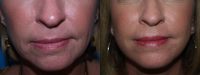 Dermabrasion for lines around the mouth