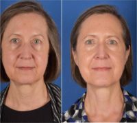 55-64 year old woman treated with Ultherapy