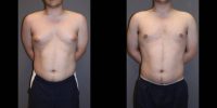 25-34 year old man treated for Male Breast Reduction