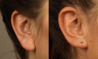 25-34 year old woman treated with Earlobe Surgery