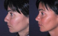 25-34 year old woman treated with Nose Surgery