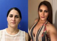 25-34 year old woman treated with Facial Feminization Surgery