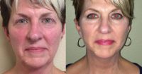 55-65 year old woman treated with Facelift