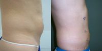 25-34 year old man treated with Slim Lipo