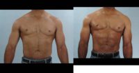 53 year old man treated for Liposuction