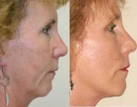 51 year old woman treated with Neck Lift