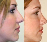 21 year old woman treated with Rhinoplasty