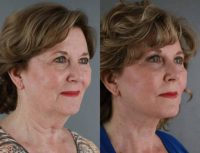 66 year old woman treated with Facelift