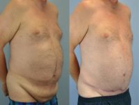 55-64 year old man treated with Male Tummy Tuck