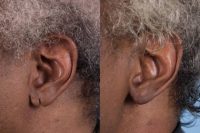 55-64 year old man treated with Ear Lobe Surgery
