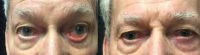 75 and up year old man treated with Lower Eyelid Surgery