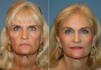 Endoscopic Composite Facelift Endoscopic Browlift Sciton Laser resurfacing to eyes and mouth