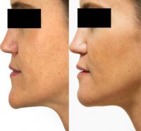 35-44 year old woman treated with Chin Surgery