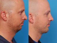 35-44 year old male treated with Rhinoplasty