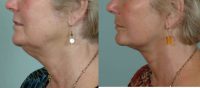 62 year old female that underwent a facelift