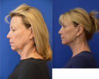 55-64 year old woman treated with Neck Lift