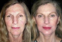 Facelift-Before & After