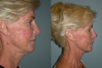 Face and neck lift on a 68 year-old woman.