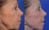 63 year old woman post Facelift