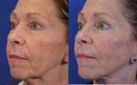63 year old woman post Facelift