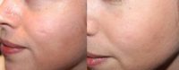 Woman wanted scar treatment