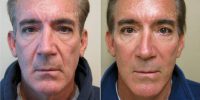 Dr. Scott K. Thompson, MD, Salt Lake City Facial Plastic Surgeon - 59 Year-old Man With Facelift